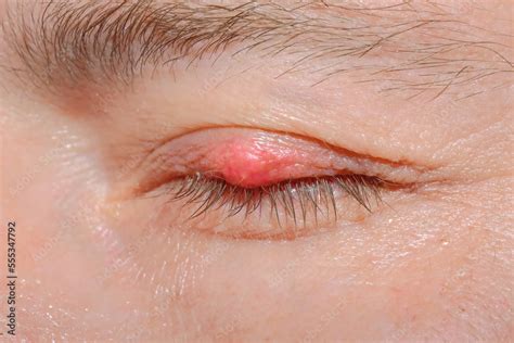 Folliculitis on eyelid  Blepharitis is very common, especially among people who have oily skin, dandruff or rosacea